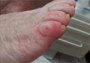 cor au pied