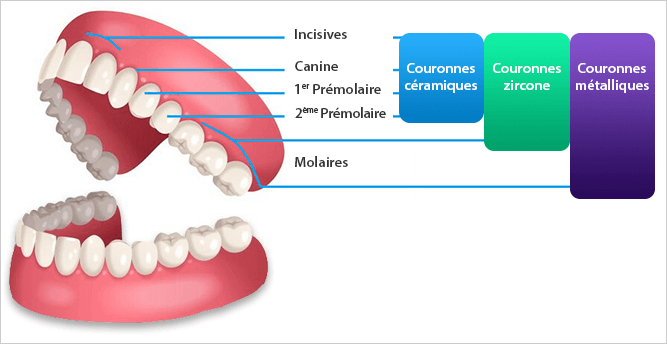 Remboursement prothèses dentaires 100% santé