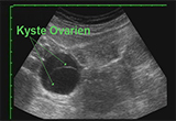 kyste ovarien