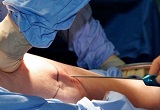 Liposuccion
