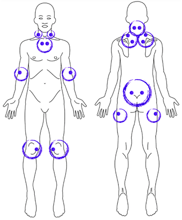 Les points d’acupression impliquées dans le soulagement de la fibromyalgie