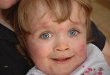 Urticaire Chez Le Bebe Dermatose Aigue Du Nourrisson Urticaire Chez Le Bebe Dermatose Aigue Du Nourrisson